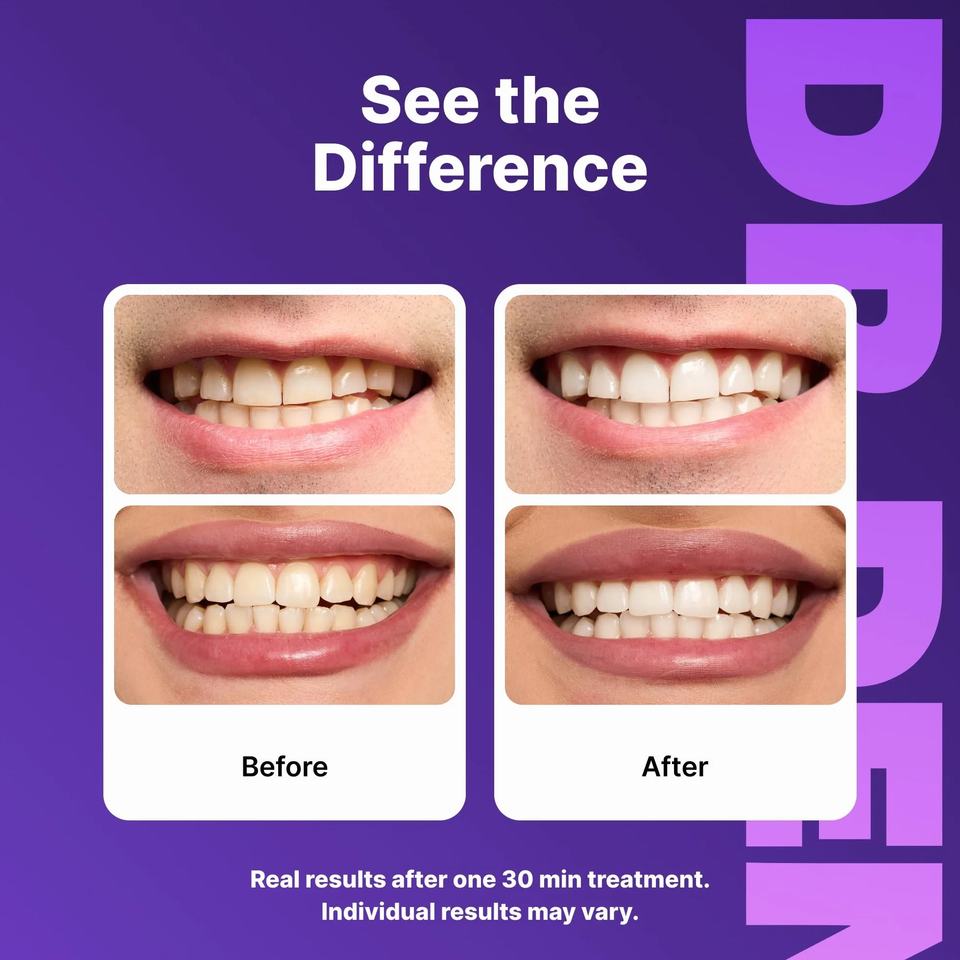 DRDENT Strisce sbiancanti denti viola 21 applicazioni 42 strisce + apri